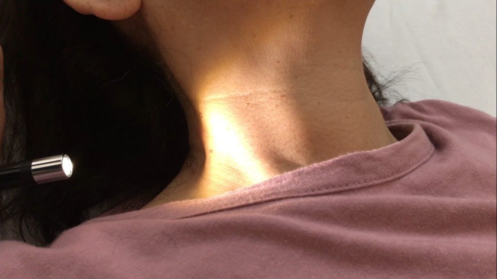 教育回診：JVP(内頸静脈圧)の観察法 みみはら研修医 Real Time Line